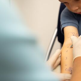 Kleiner Junge erhält auf dem Unterarm einen Allergietest